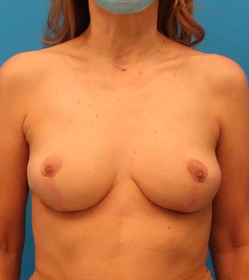 after breast implant removal front view case 3148